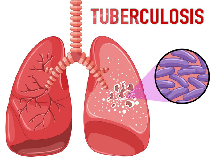 tuberk.jpg